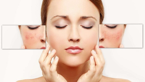 Sai lầm trong cách trị nám da chị em hay mắc phải Sai lầm trong cách trị nám da chị em hay mắc phải