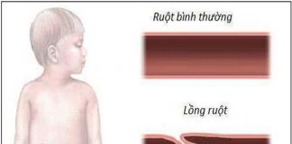 Những điều cần biết về bệnh lồng ruột ở trẻ em