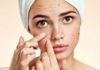 Hướng dẫn chi tiết cách dùng dầu dừa trị mụn tại nhà siêu hiệu quả