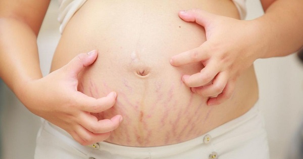 Những đối tượng nào dễ bị rạn da