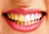 răng bị ố vàng thì phải làm sao