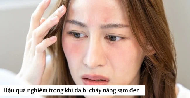 Cách phòng tránh da bị cháy nắng khi đi biển