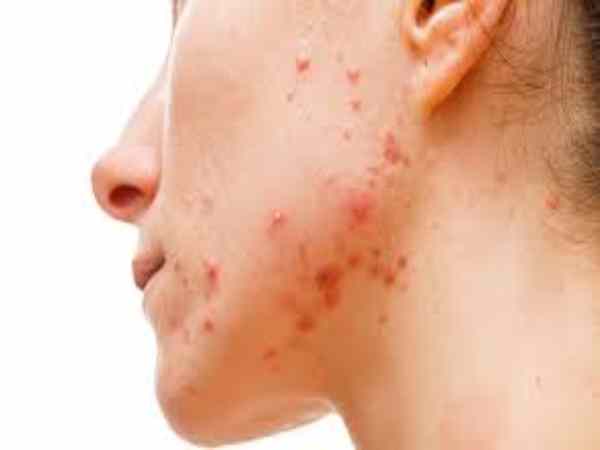 trị mụn nội tiết