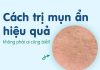 Cách trị mụn ẩn tại nhà hiệu quả ai cũng làm được