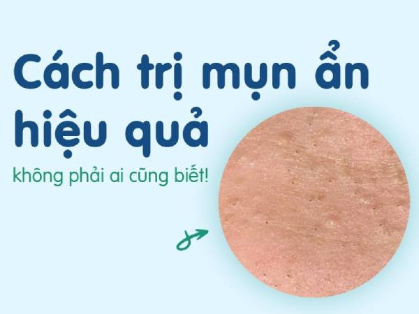 Cách trị mụn ẩn tại nhà hiệu quả ai cũng làm được