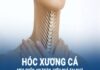 Làm gì khi bị hóc xương cá