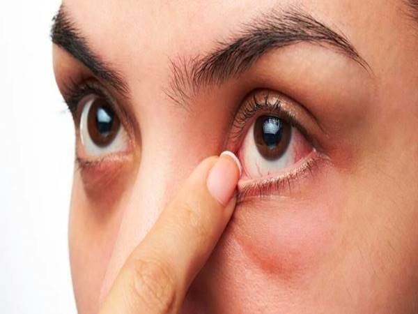 Mẹo chữa ngứa khóe mắt đơn giản