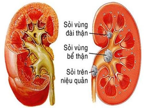 Sỏi thận hình thành trong bao lâu ảnh hưởng thế nào tới sức khỏe